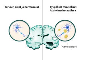 Suomen Seniorihoiva - Alzheimerin tauti ensioireet - Alzheimerin taudin ensioireet - Alzheimer oireet - Alzheimer ensioireet