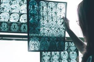 Alzheimerin tauti ensioireet - Alzheimerin taudin ensioireet - Magneettikuvaus