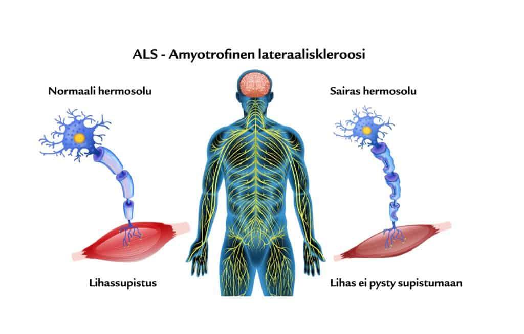 ALS tauti oireet - ALS sairaus - ALS testi - ALS ensioireet