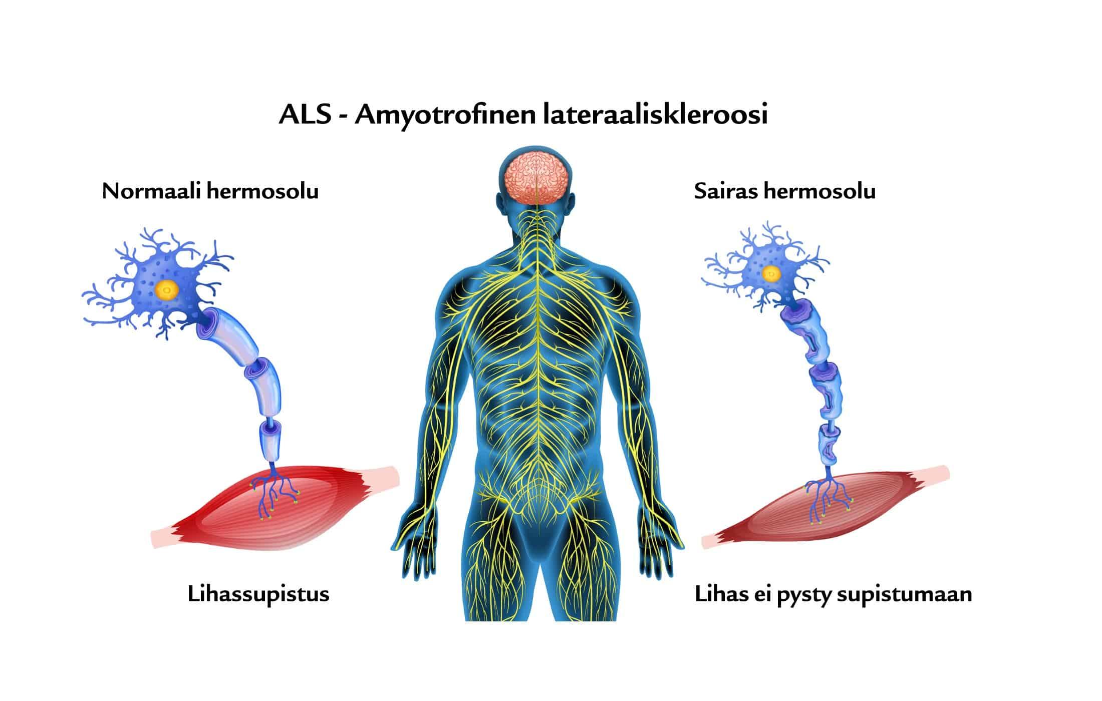 ALS-tauti – oireet, terapia ja hoito | Suomen Seniorihoiva
