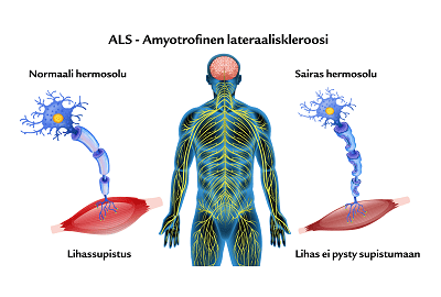 ALS tauti - Suomen Seniorihoiva