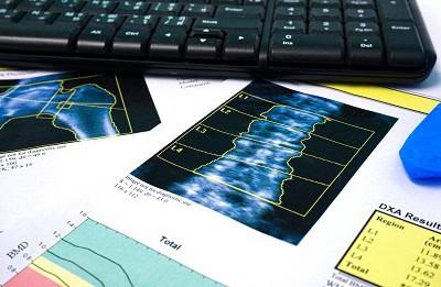 Osteoporoosi oireet hoito - Suomen Seniorihoiva